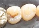 Kyle Chock #29 amalgam removal