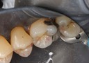 Kyle Chock #3 pre-op buccal view