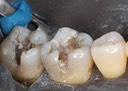 Kyle Chock #30-31 amalgam removal 2