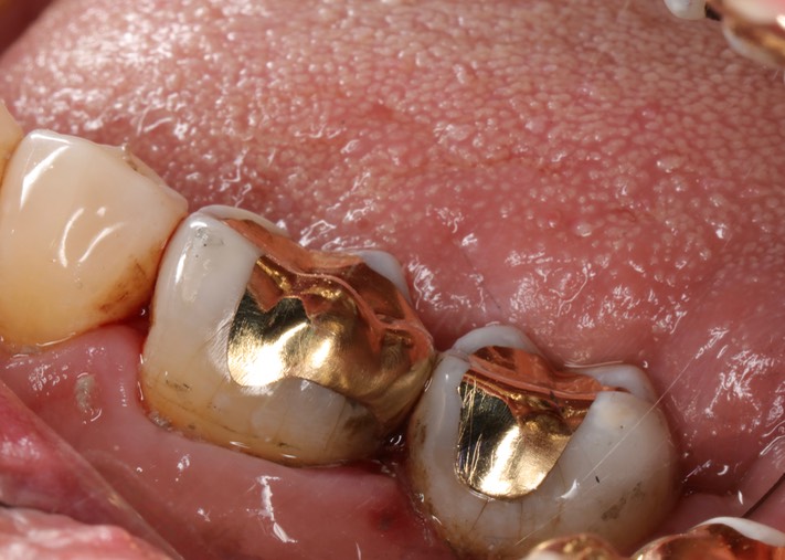 Kyle Chock #30-31 finish buccal view