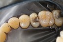 Kyle Chock #4 amalgam removal