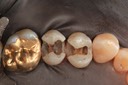 Kyle Chock #12-13 caries removal