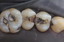 Larry Fujioka #12-13 amalgam removal