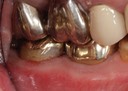 Larry Fujioka #13 buccal view