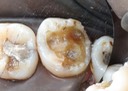 Larry Fujioka #2 caries removal