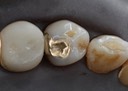 Larry Fujioka #28 pre-cementation