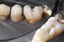 Larry Fujioka #30 buccal prep