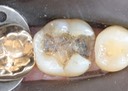 Larry Fujioka #30 caries removal