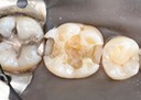 Larry Fujioka #30 caries removal 