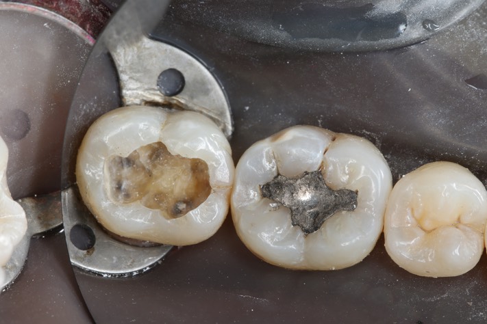 Larry Fujioka #31 amalgam removal