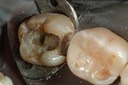 Larry Fujioka #31 caries removal