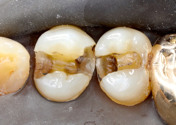 Larry Fujioka #4-5 amalgam removal 2