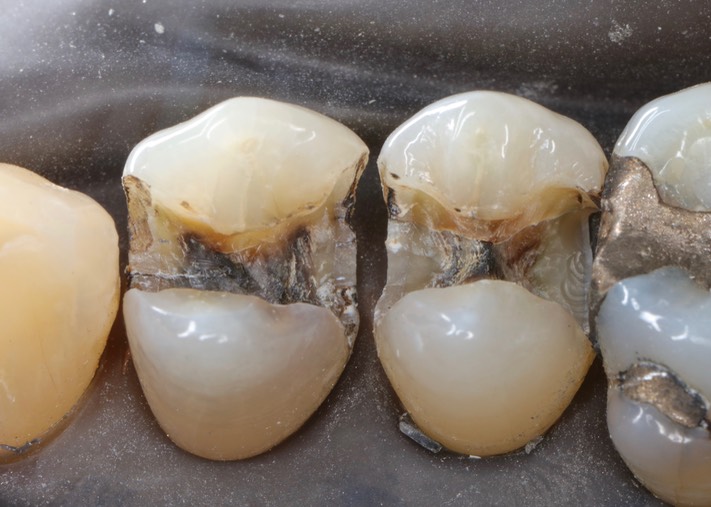 Larry Fujioka #4-5 amalgam removal
