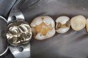 Larry Fujioka#29-30 amalgam removal
