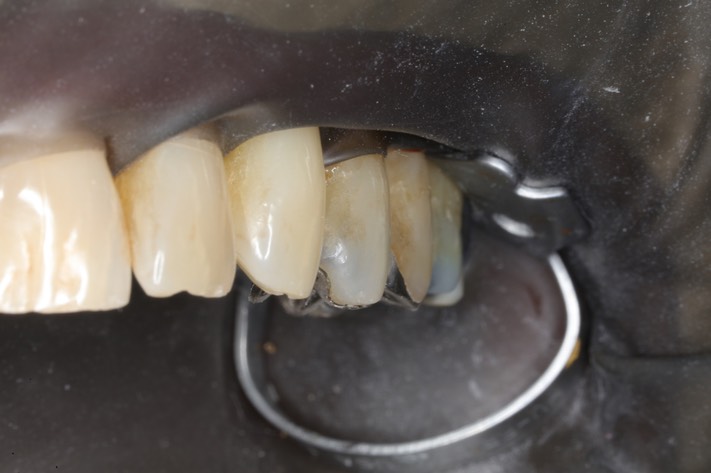 Mark Chun #12 buccal view