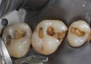 Mark Chun #13,14,15 amalgam removal