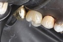Mark Chun #14 buccal view