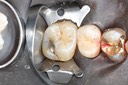 Mark Chun #14 pre-op