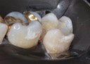 Mark Chun #2 prep buccal view