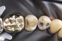 Mark Chun #29 amalgam removal