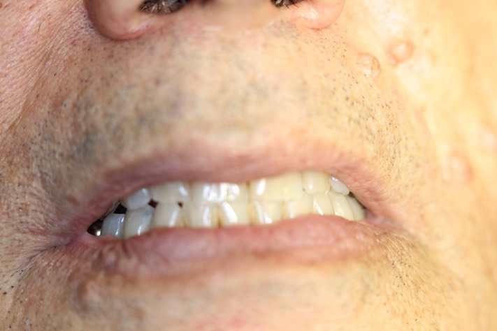 Mark Chun pre-op