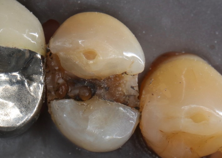 Matt Dodson #12 amalgam removal – Version 2