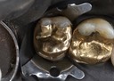 Matt Dodson #15 pre-cementation
