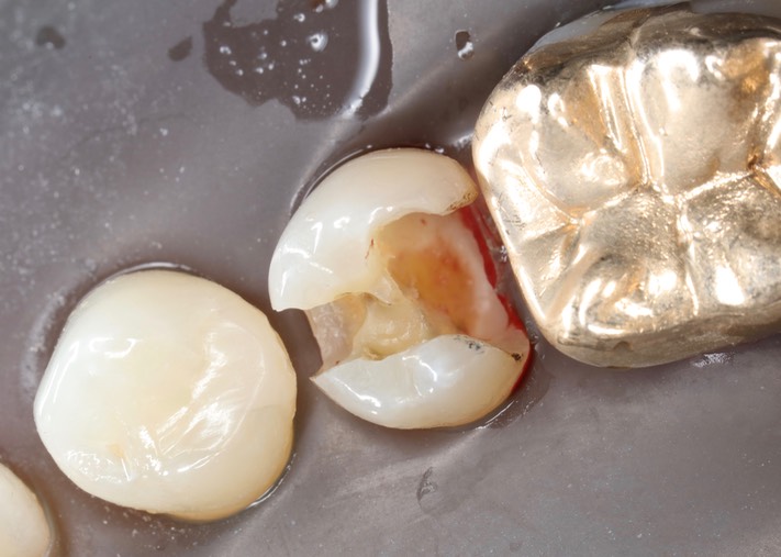 Matt Dodson #20 caries removal 