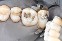 Matt Dodson #3-4 amalgam removal