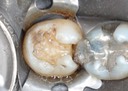 Matt Dodson #31 amalgam removal