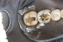 Matt Dodson #31 amalgam removal