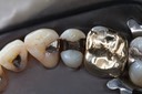Matt Dodson #5 amalgam removal