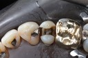 Matt Dodson #5 caries removal