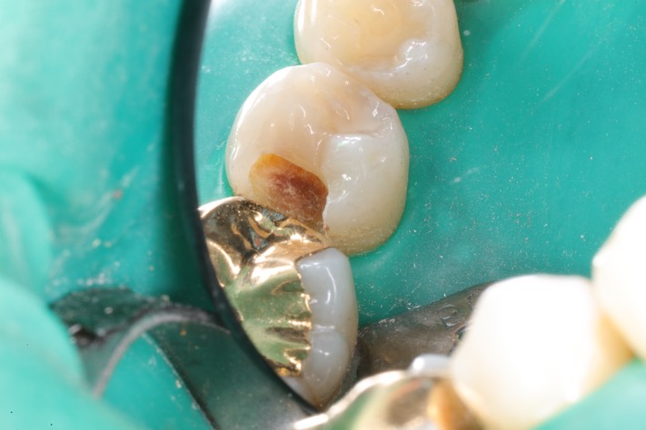 Mendel Sato #29 caries removal