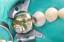 Mendel Sato #29 pre-op