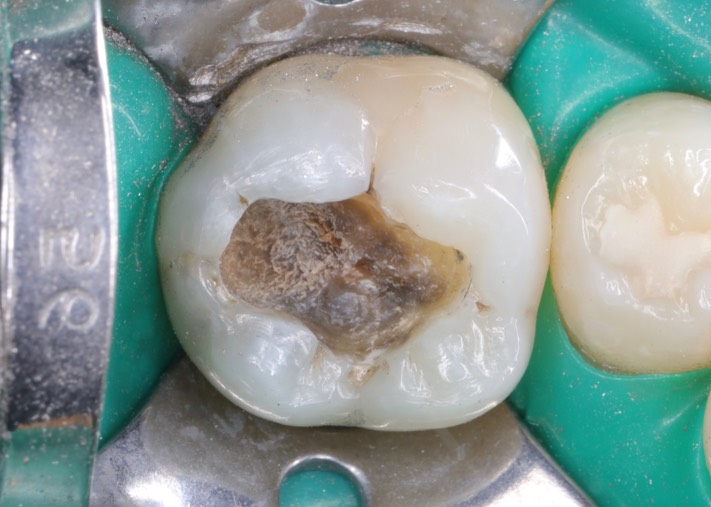Mendel Sato #30 caries removal