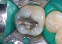Mendel Sato #30 pre-op