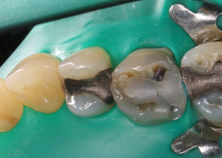 Mendel Sato #5 pre-op
