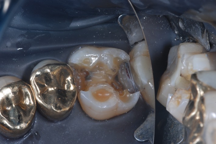 Mitchell Chun #3 amalgam removal