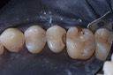 Nina Hayashi #4 composite removal