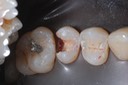 Roland Ylarde #13 amalgam removal