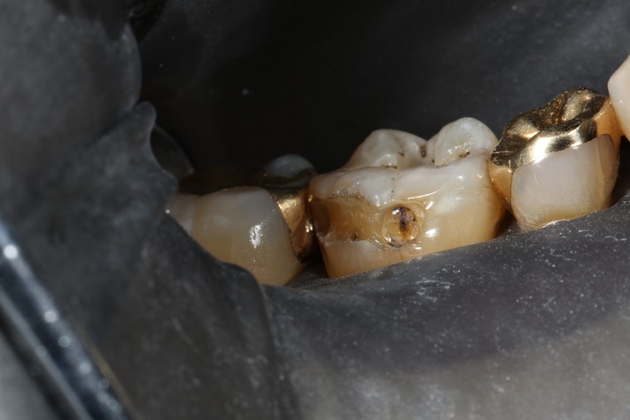 Russ Tabata #30 amalgam removal