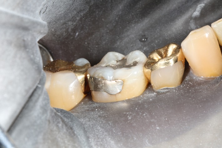 Russ Tabata #30 buccal pre-op