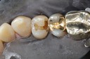 Russ Tabata #5 amalgam removal