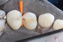 Scott Kanamori #12 caries removal