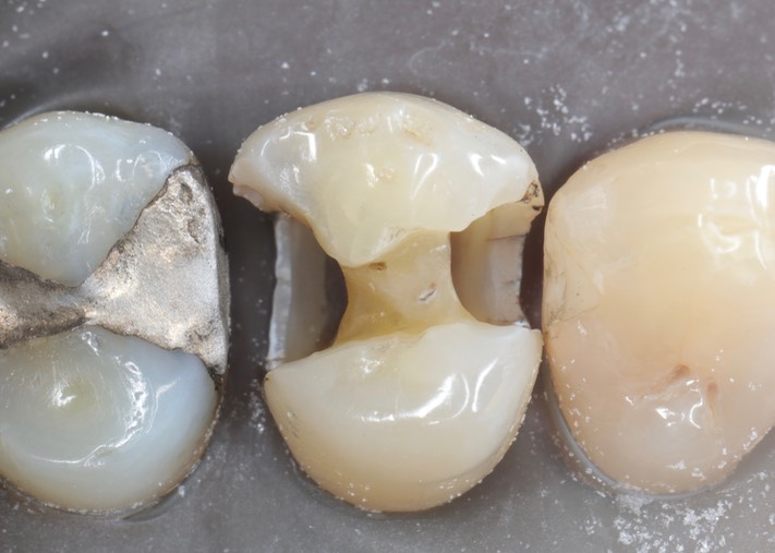 Scott Kanamori #12 caries removal