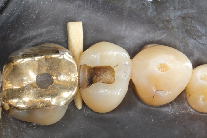 Scott Kanamori #13 amalgam removal