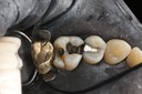 Scott Kanamori #14 caries removal