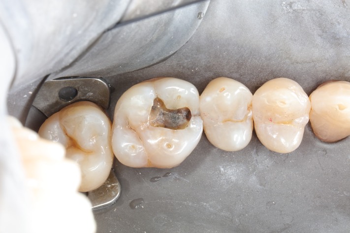Scott Kanamori #14 caries removal