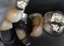 Scott Kanamori #15 composite removal